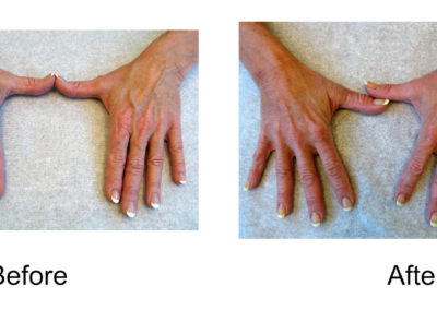 Hand Veins Comparison 01