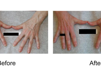 Hand Veins Comparison 02