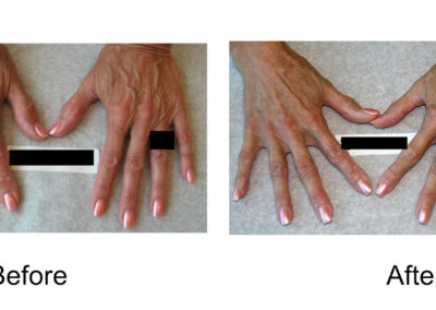 Hand Veins Comparison 04