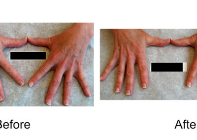 Hand Veins Comparison 05