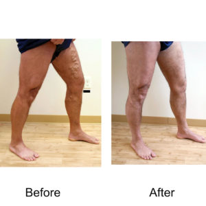 Varicose Veins before and after