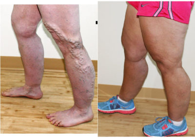 Varicose Veins Before and After