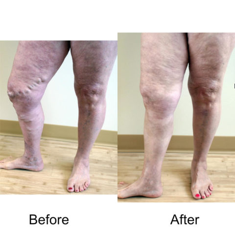 Varicose Vein Treatments 