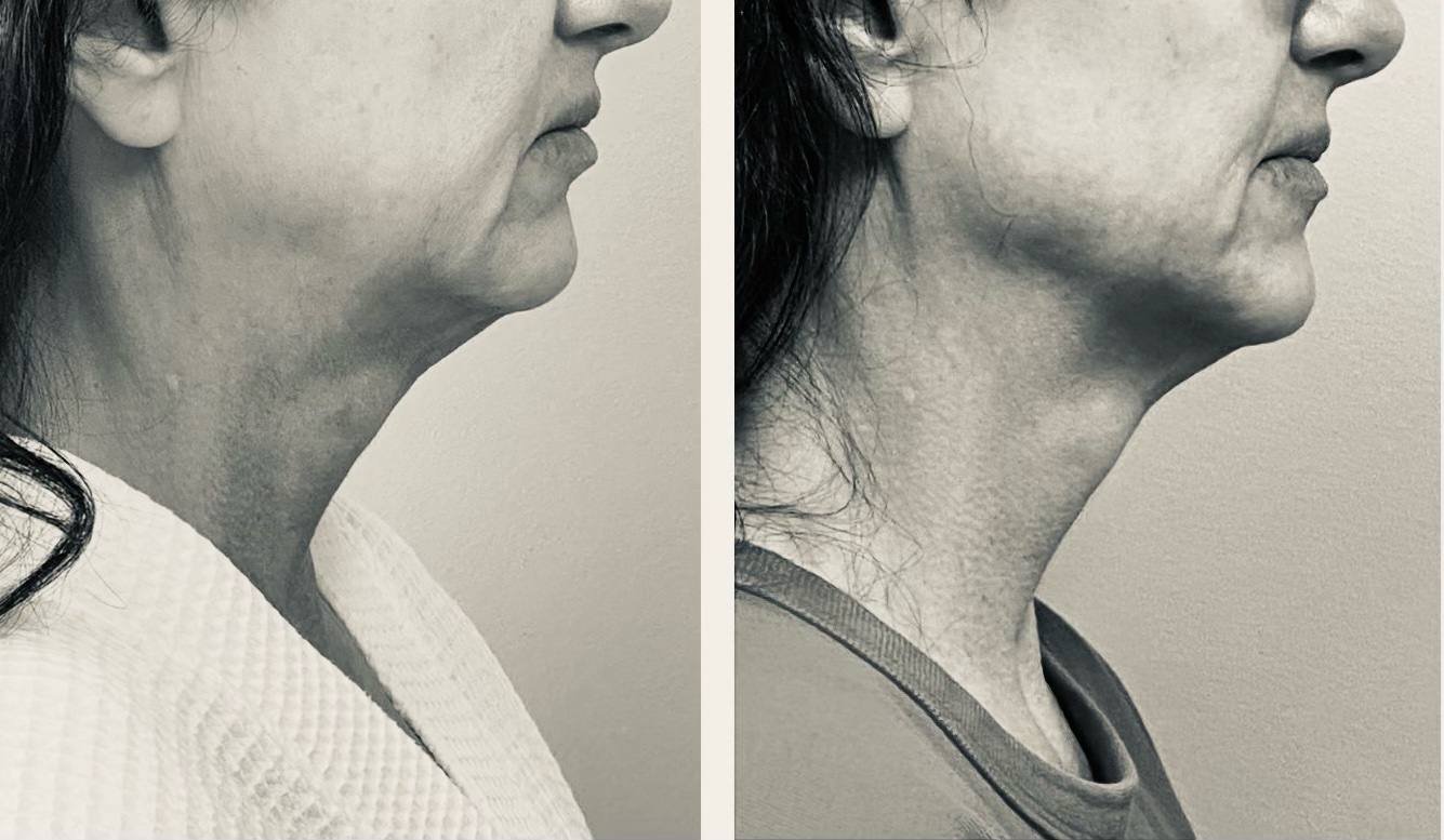 Indiba Jowls and Upper Neck
