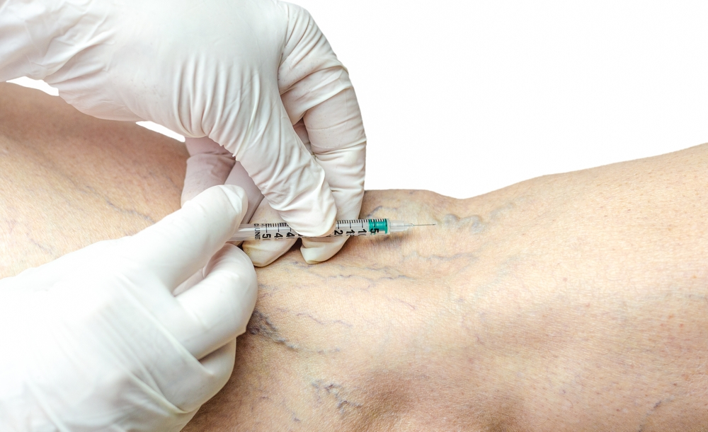 How to Treat Your Hand Veins with Sclerotherapy